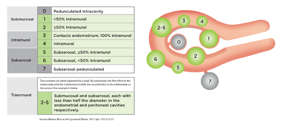 Типы миомы матки по figo. Классификация миомы по Фиго. Миома матки Figo. Классификация миом матки по УЗИ. Классификация Фиго миома матки.